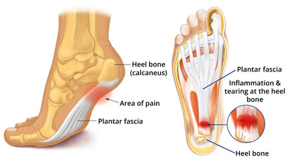 Revolusjonerende ortopedisk innleggssåle